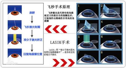 激光在治療近視方面的應用